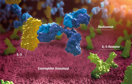 Was ist Esiphoniles Asthma?